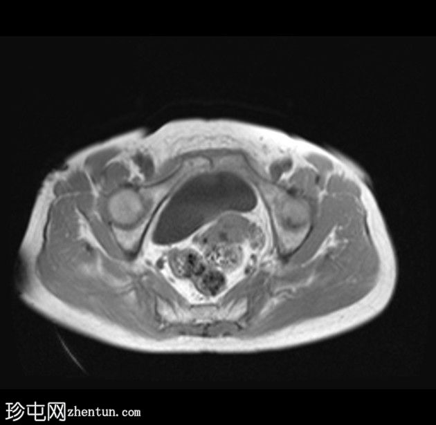 带蒂动脉征的子宫内膜息肉(MRI)