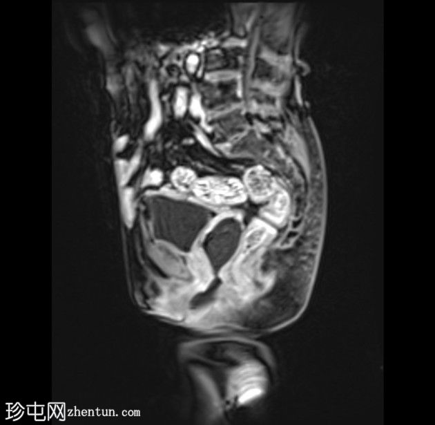 带蒂动脉征的子宫内膜息肉(MRI)