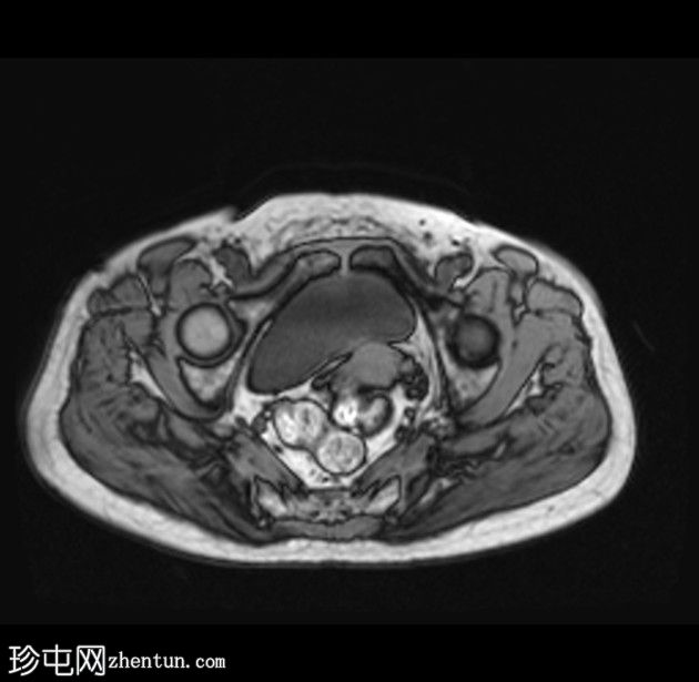 带蒂动脉征的子宫内膜息肉(MRI)