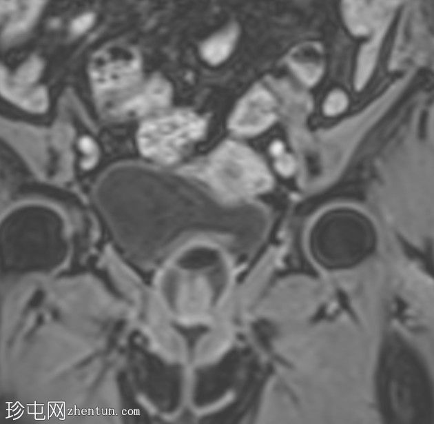 带蒂动脉征的子宫内膜息肉(MRI)