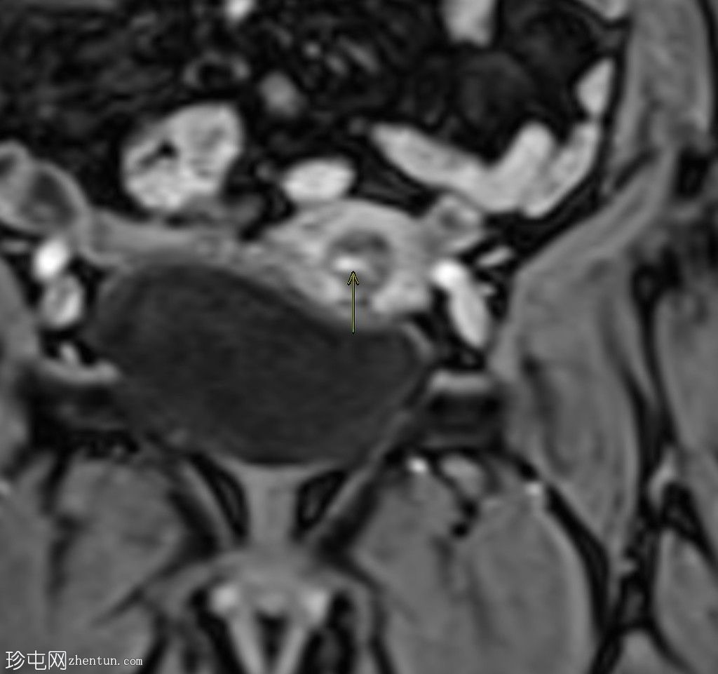 带蒂动脉征的子宫内膜息肉(MRI)