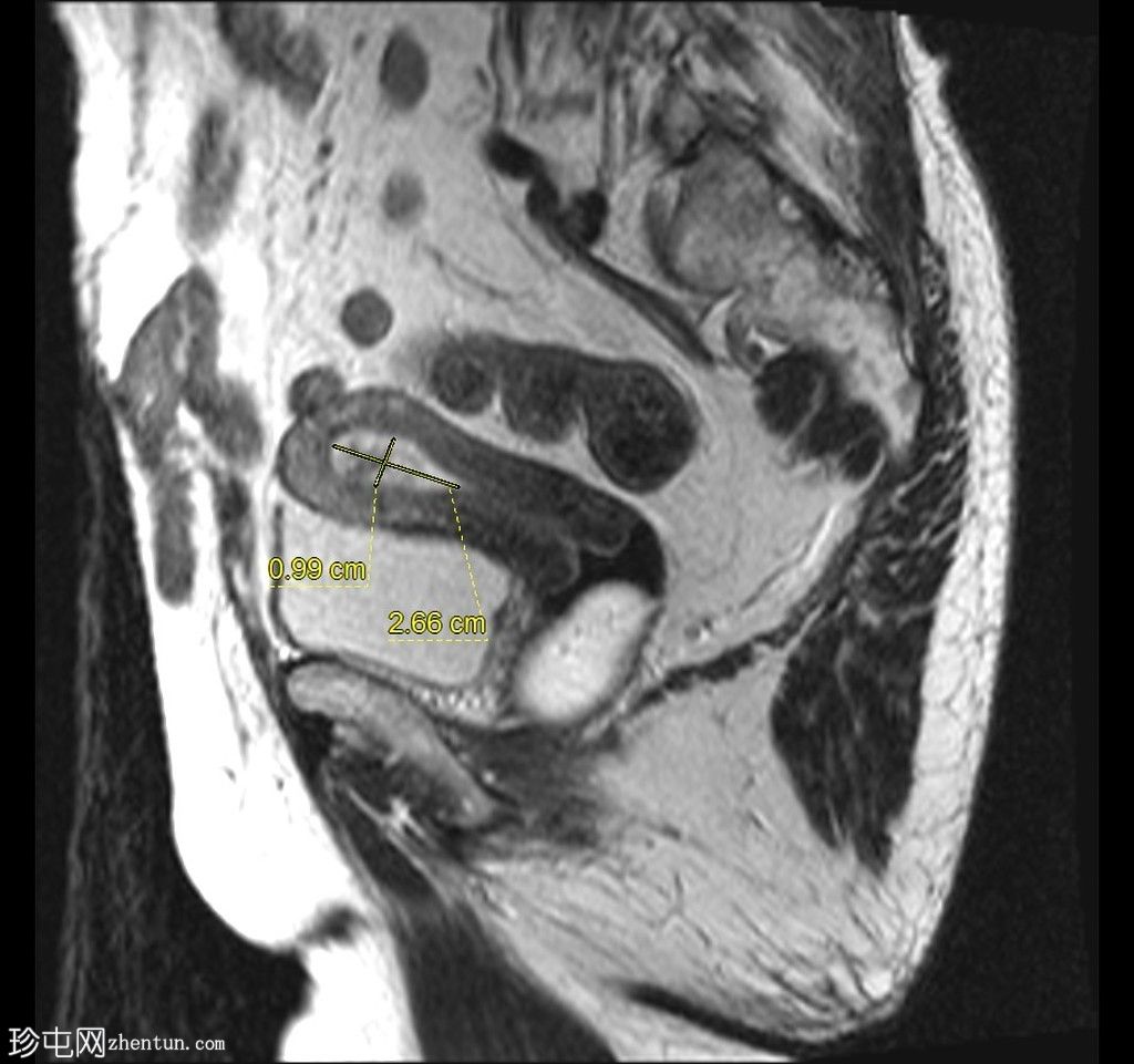 带蒂动脉征的子宫内膜息肉(MRI)