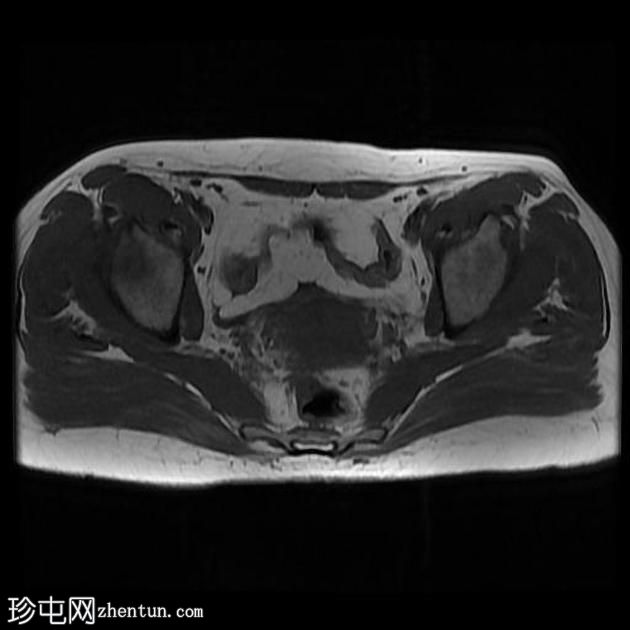 骨盆深部子宫内膜异位症(MRI)