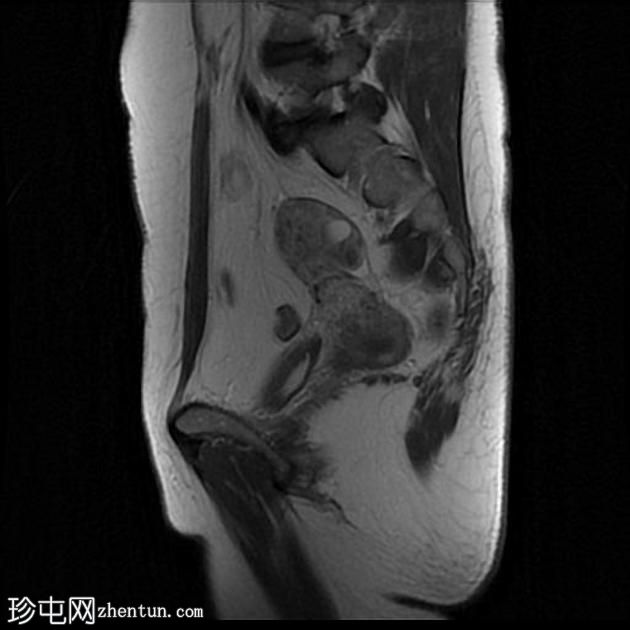 骨盆深部子宫内膜异位症(MRI)