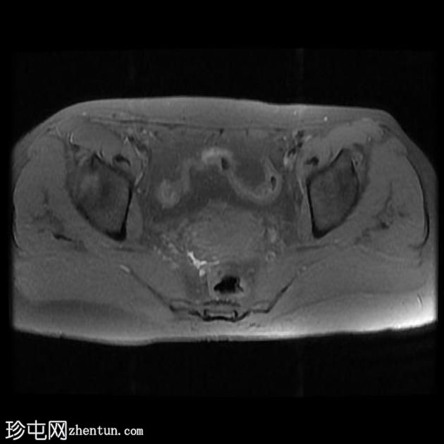 骨盆深部子宫内膜异位症(MRI)