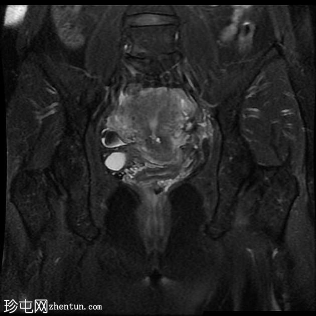 骨盆深部子宫内膜异位症(MRI)