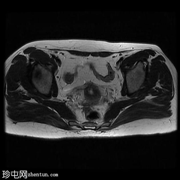 骨盆深部子宫内膜异位症(MRI)