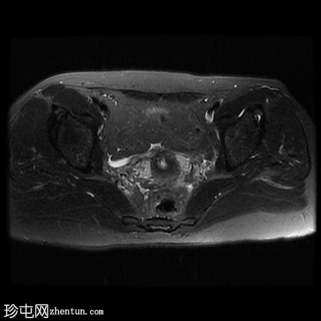 骨盆深部子宫内膜异位症(MRI)