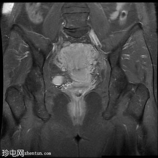 骨盆深部子宫内膜异位症(MRI)