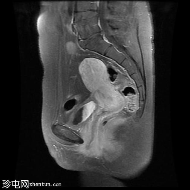 骨盆深部子宫内膜异位症(MRI)