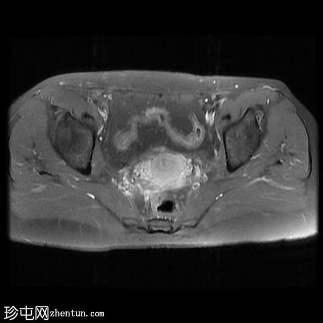 骨盆深部子宫内膜异位症(MRI)