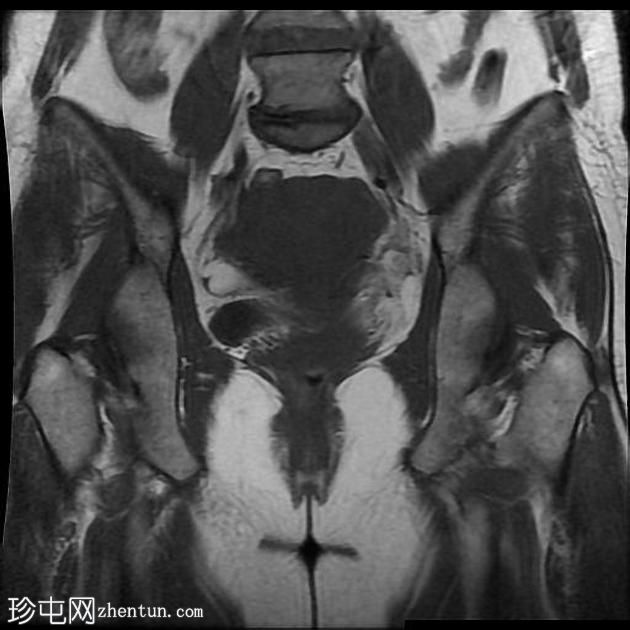 骨盆深部子宫内膜异位症(MRI)