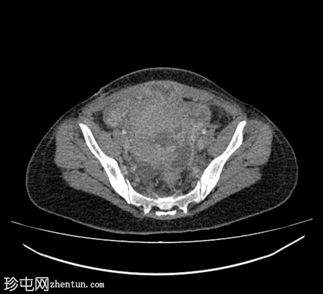 子宫破裂伴腹部棉膜瘤