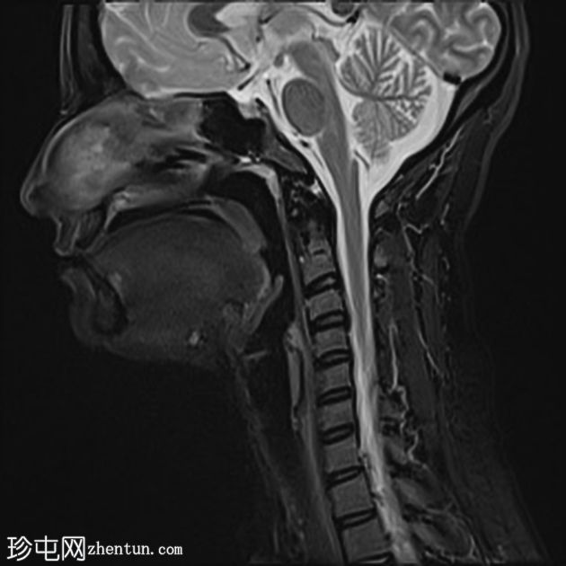 下颌下神经鞘瘤