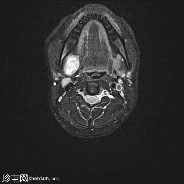 下颌下神经鞘瘤