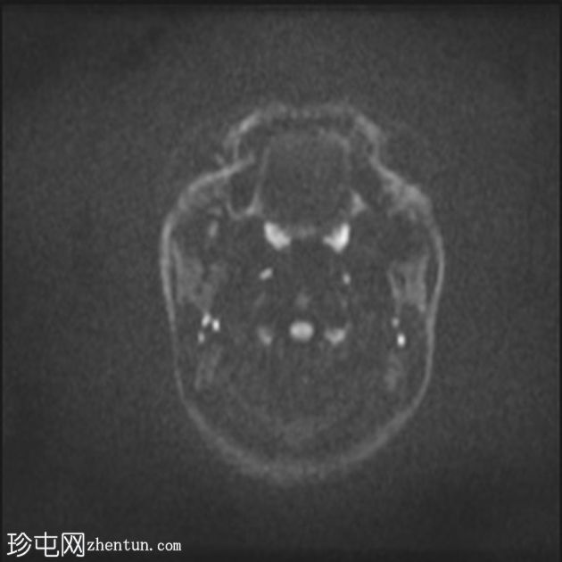 下颌下神经鞘瘤