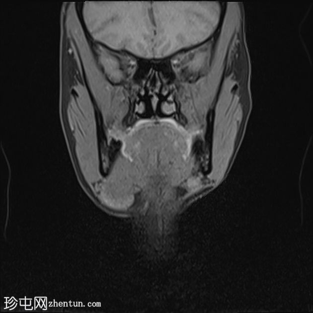 下颌下神经鞘瘤