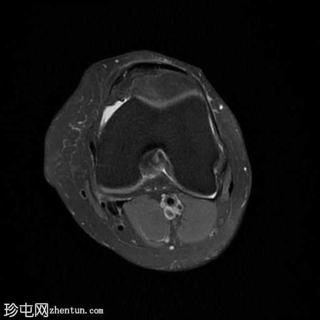 关节内脂肪瘤-膝关节