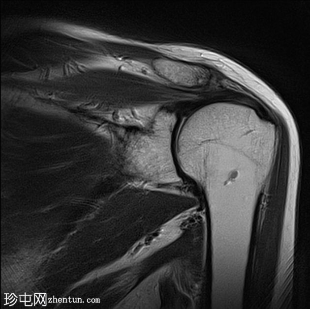 喙突骨折基底部