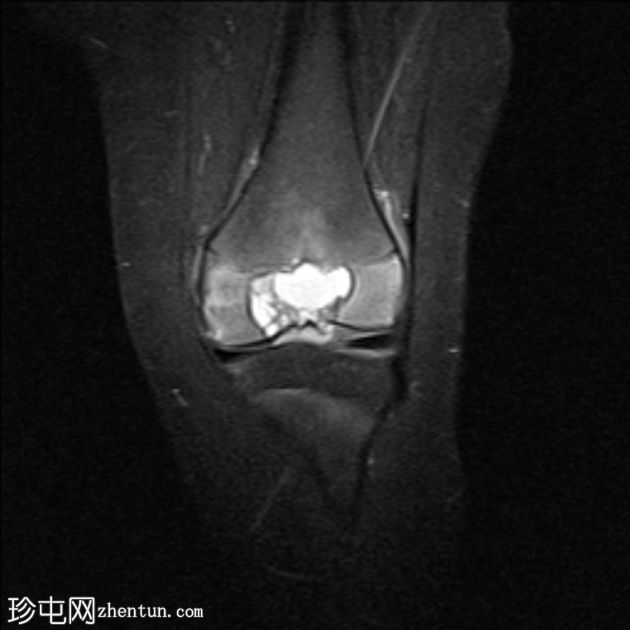 骨骺动脉瘤样骨囊肿