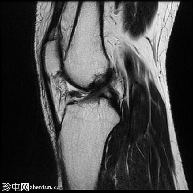 盘状内侧半月板-双侧