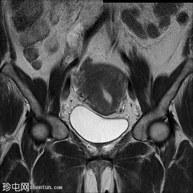 子宫子宫腺肌症-子宫腺肌瘤