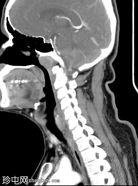 鼻咽癌转移性颈部淋巴结病