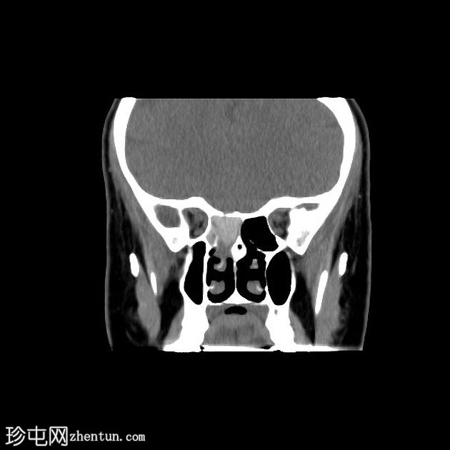 真菌性鼻窦炎——假性充气性鼻窦