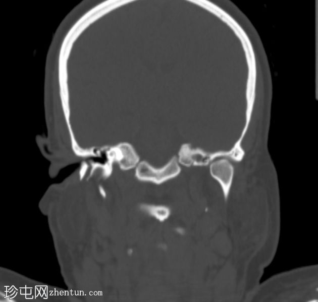 下颌骨折伴颞下颌关节脱位和咀嚼间隙爆裂骨折