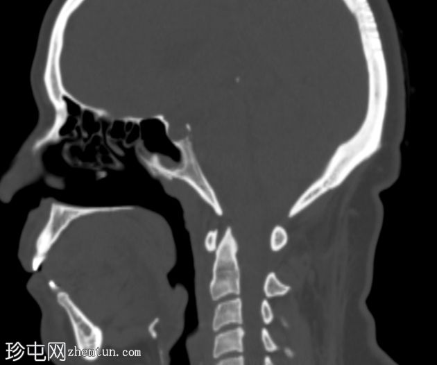 下颌骨折伴颞下颌关节脱位和咀嚼间隙爆裂骨折