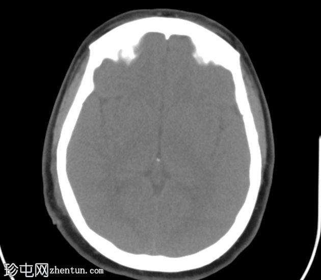 下颌骨折伴颞下颌关节脱位和咀嚼间隙爆裂骨折