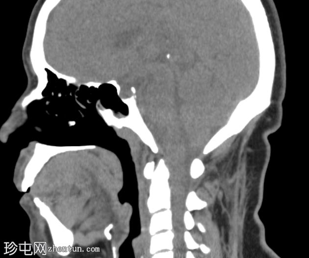 下颌骨折伴颞下颌关节脱位和咀嚼间隙爆裂骨折