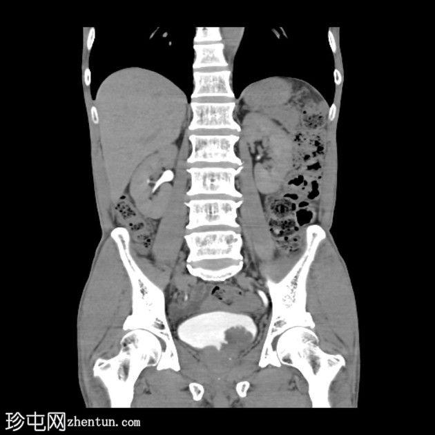 尿路上皮细胞癌(膀胱)