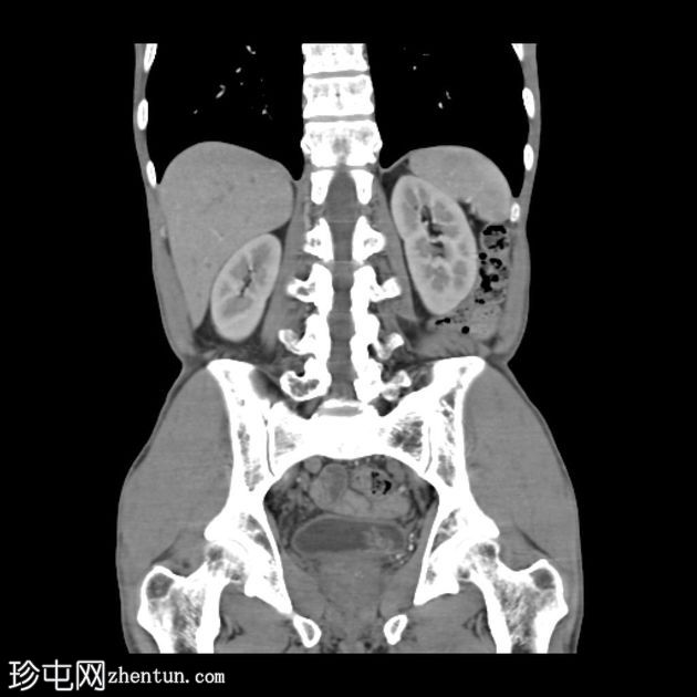 尿路上皮细胞癌(膀胱)