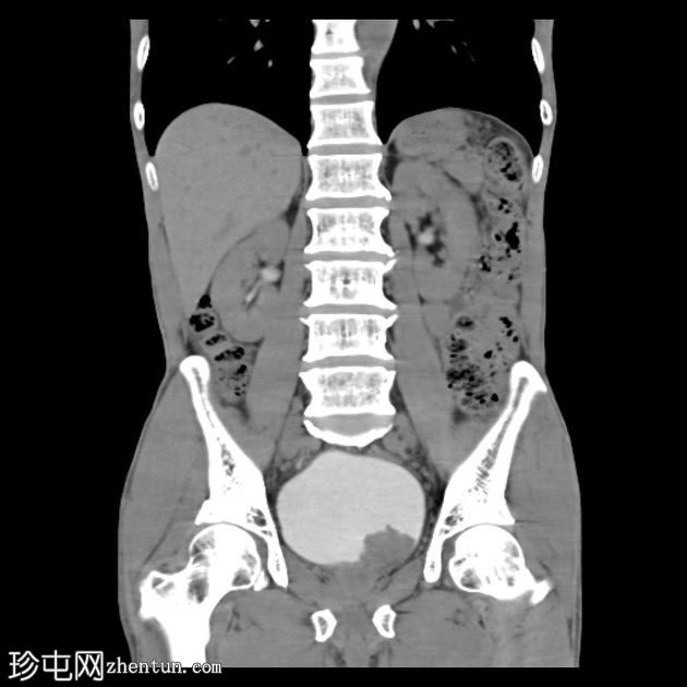 尿路上皮细胞癌(膀胱)