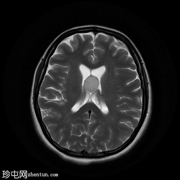 第三脑室胶体囊肿