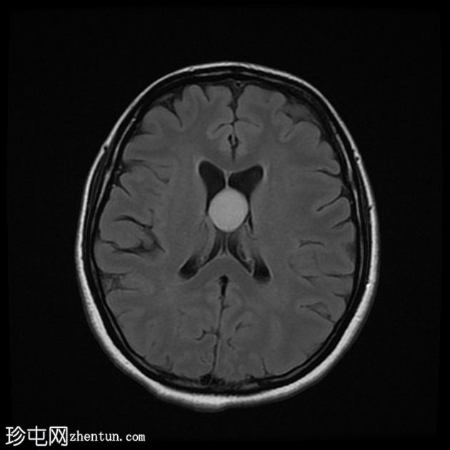 第三脑室胶体囊肿