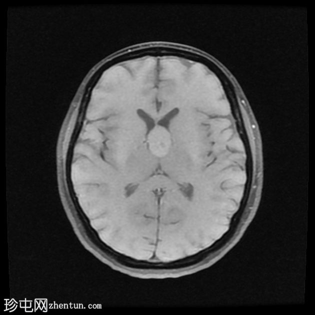 第三脑室胶体囊肿