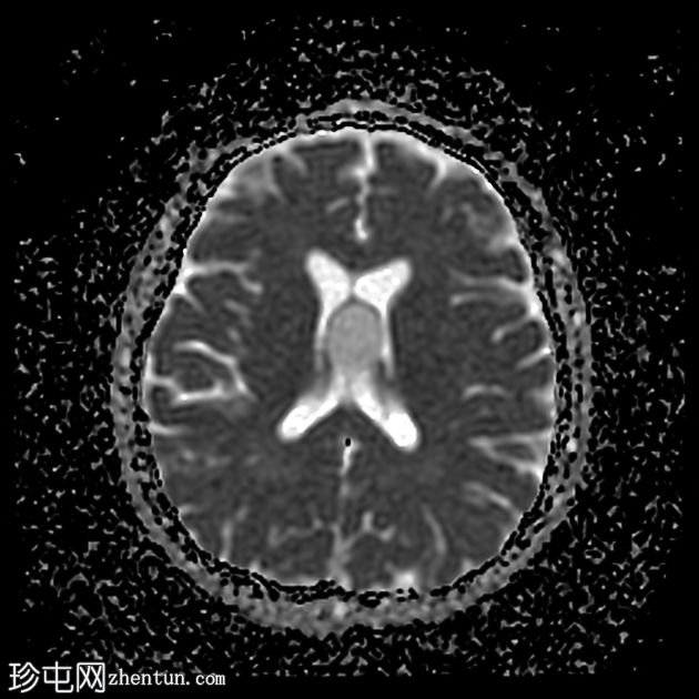 第三脑室胶体囊肿