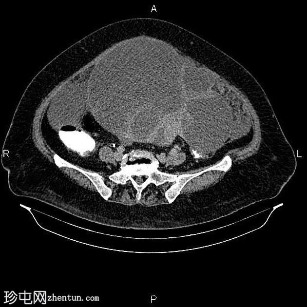 卵巢浆液性囊腺癌