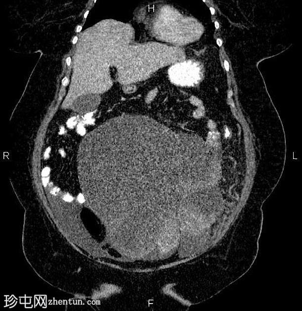 卵巢浆液性囊腺癌