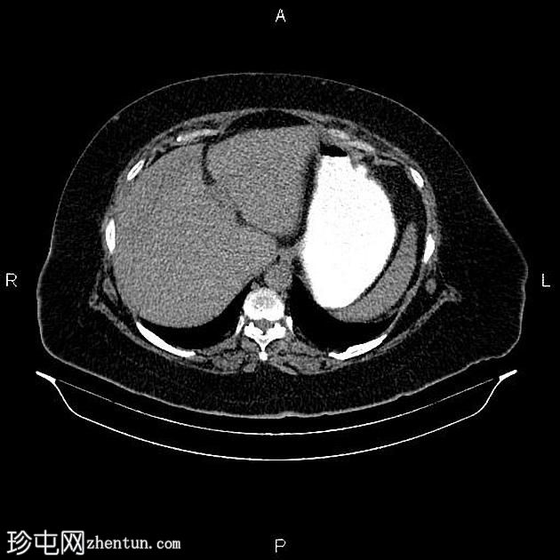 卵巢浆液性囊腺癌