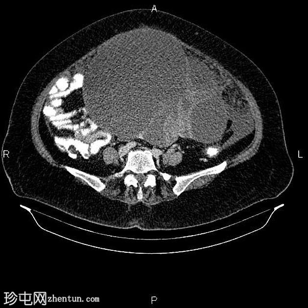 卵巢浆液性囊腺癌