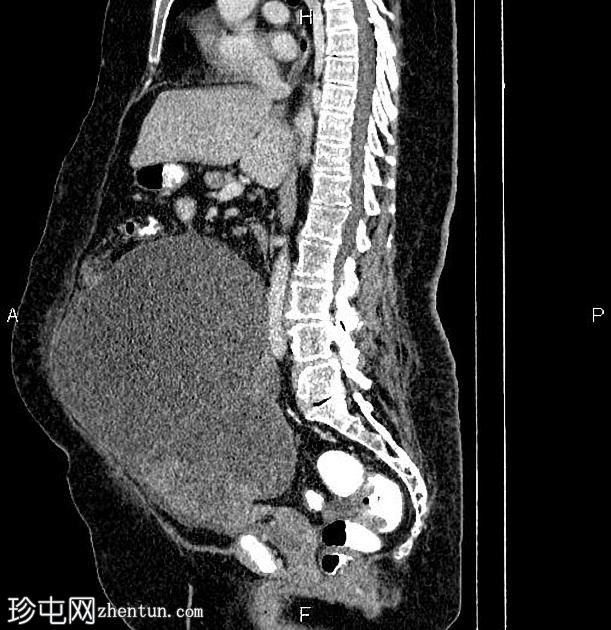 卵巢浆液性囊腺癌