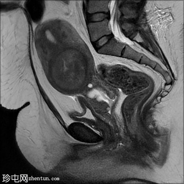 子宫肌瘤红色变性