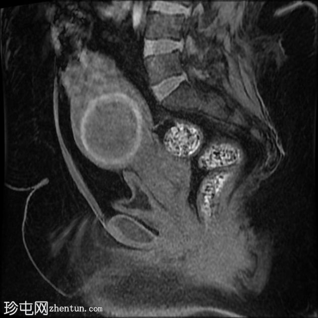 子宫肌瘤红色变性