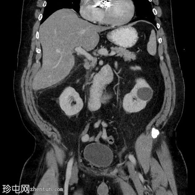 急性胆囊炎- CT