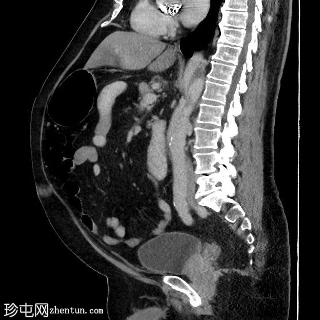 急性胆囊炎- CT