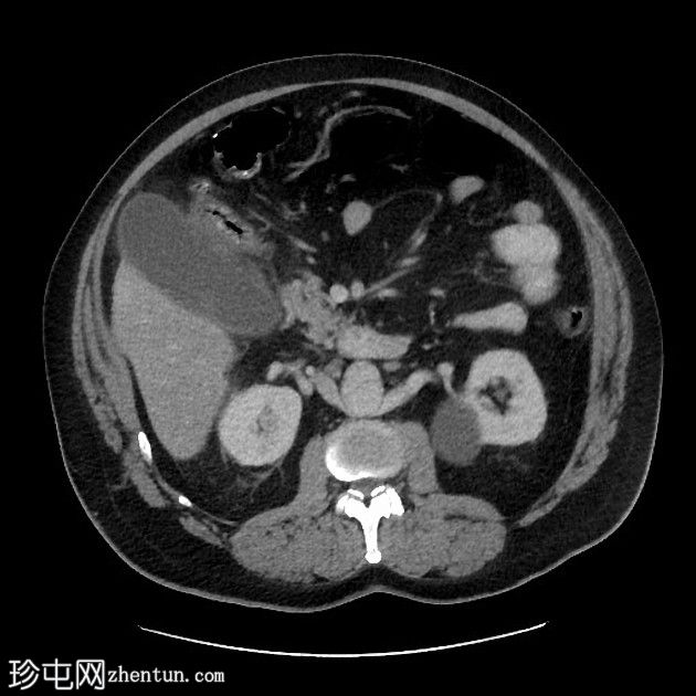 急性胆囊炎- CT