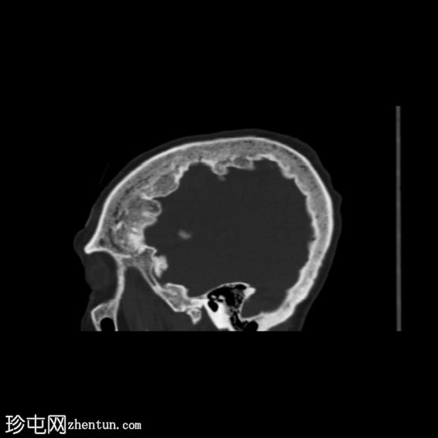 额顶骨质增生